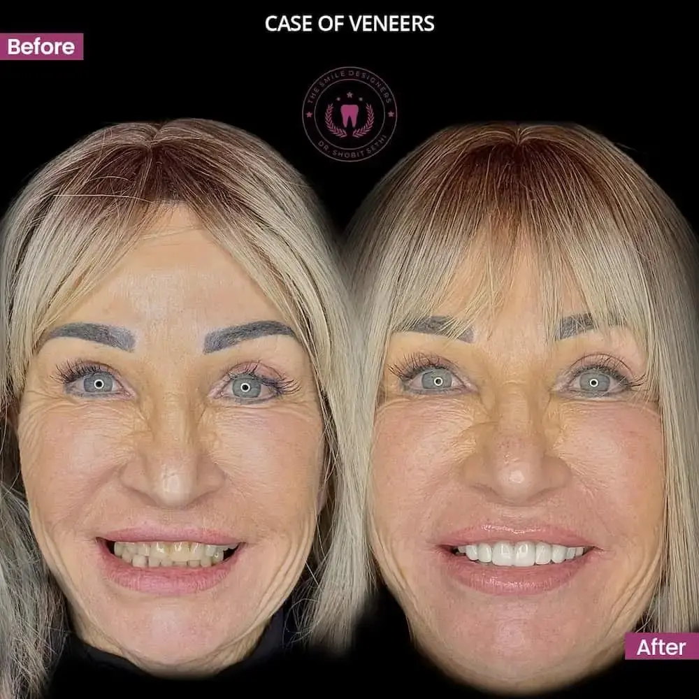 Best Dentist in Chandigarh Mohali Before-After-Photos- The Smile Designers