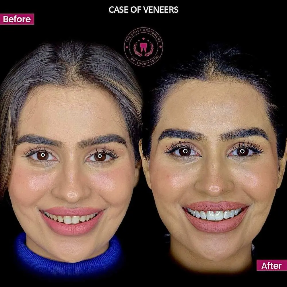 Best Dentist in Chandigarh Mohali Before-After-Veneers -Patient Photos - The Smile Designers