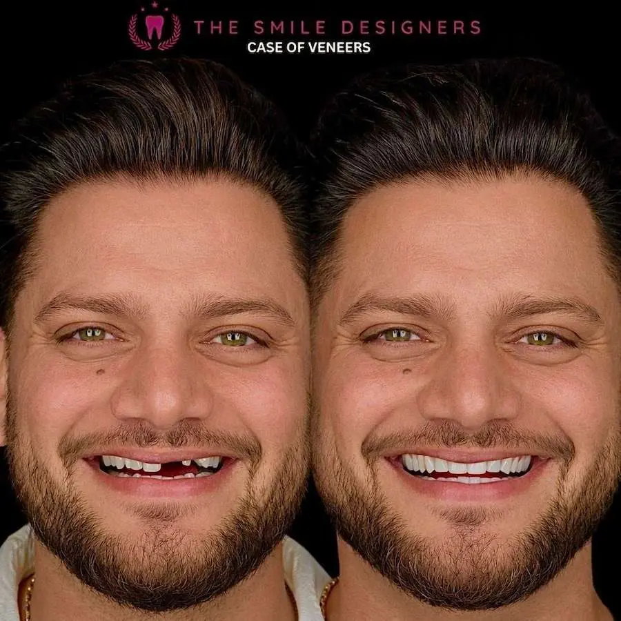 Best Dentist in Chandigarh Mohali Before-After-Venners-Patient - The Smile Designers