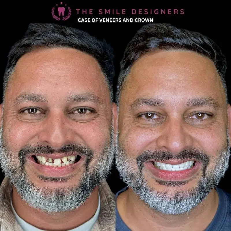 Best Dentist in Chandigarh Mohali Before-After-Venners and Crowns-Patient-Photos - The Smile Designers