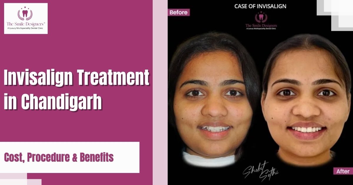 Invisalign Treatment in Chandigarh