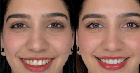 Before and After results of Smile Makeover in Chandigarh