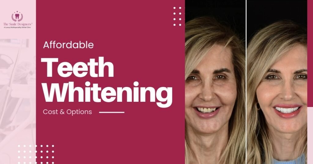 Teeth whitening in Chandigarh