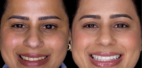 Before and After Smile Makeover in Chandigarh