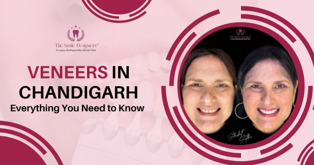 Veneers in Chandigarh