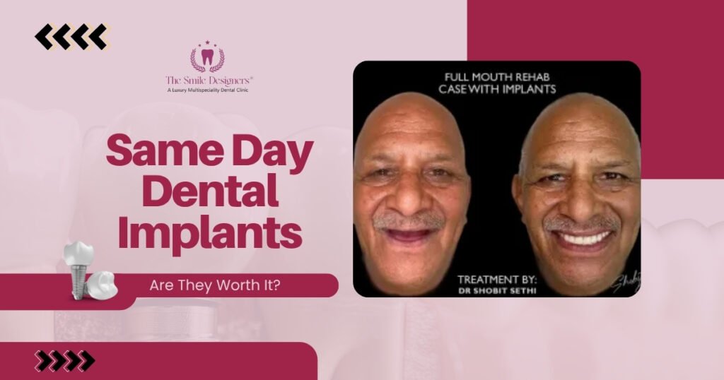 dental implants in Chandigarh
