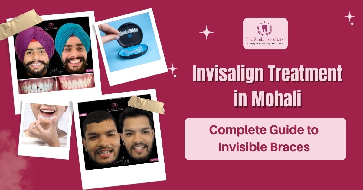 invisalign treatment in Mohali