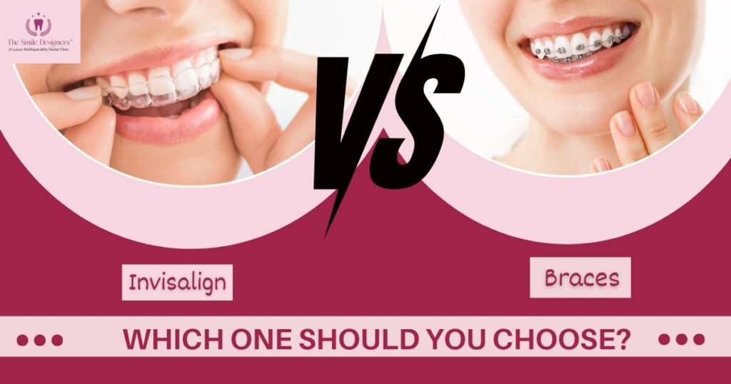 invisalign treatment in chandigarh