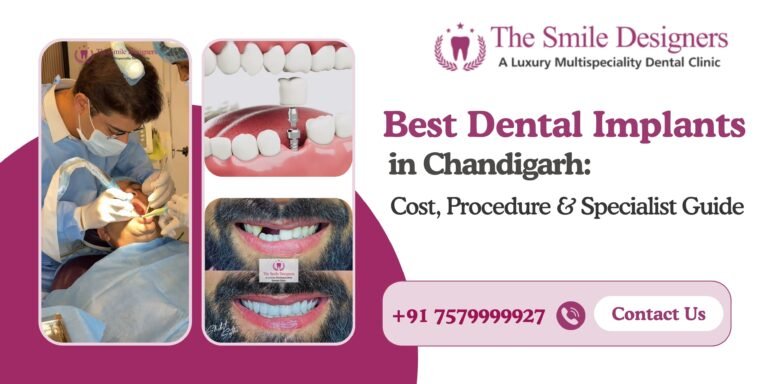 Best Dental Implants in Chandigarh