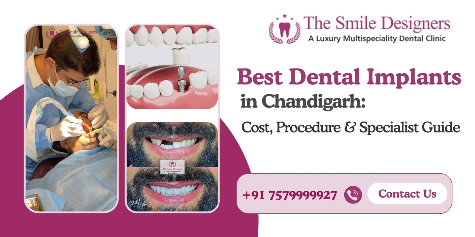 Best Dental Implants in Chandigarh