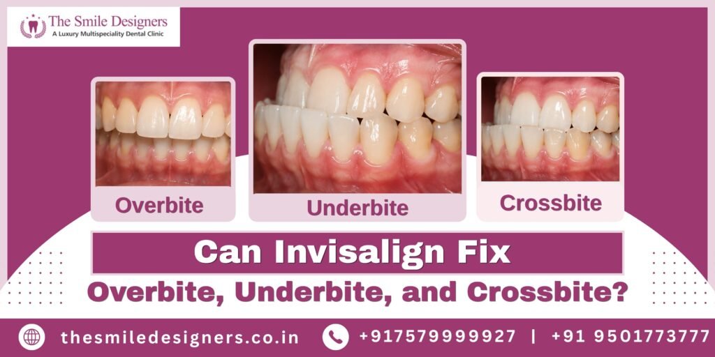 Can Invisalign Fix Overbite, Underbite, and Crossbite?