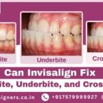 Can Invisalign Fix Overbite, Underbite, and Crossbite?
