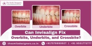 Can Invisalign Fix Overbite, Underbite, and Crossbite?