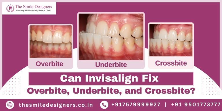 Can Invisalign Fix Overbite, Underbite & Crossbite