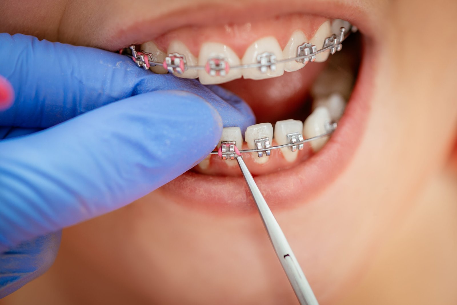 Orthodontic treatment for misaligned teeth