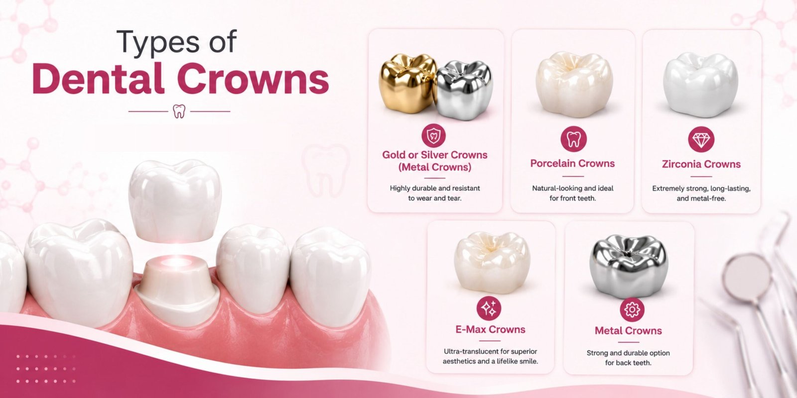Types of Dental Crowns for Teeth