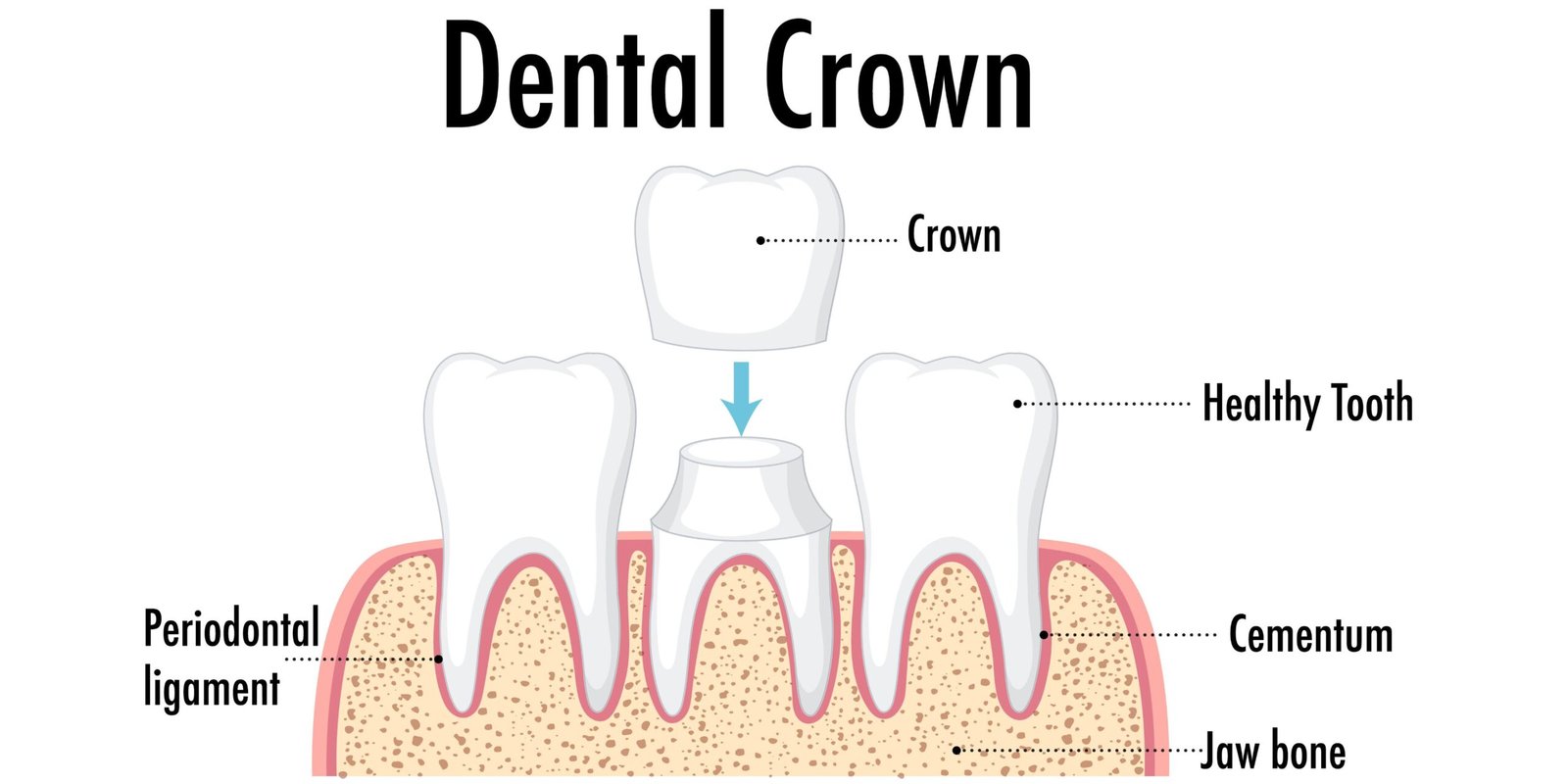 What is a Dental Crown
