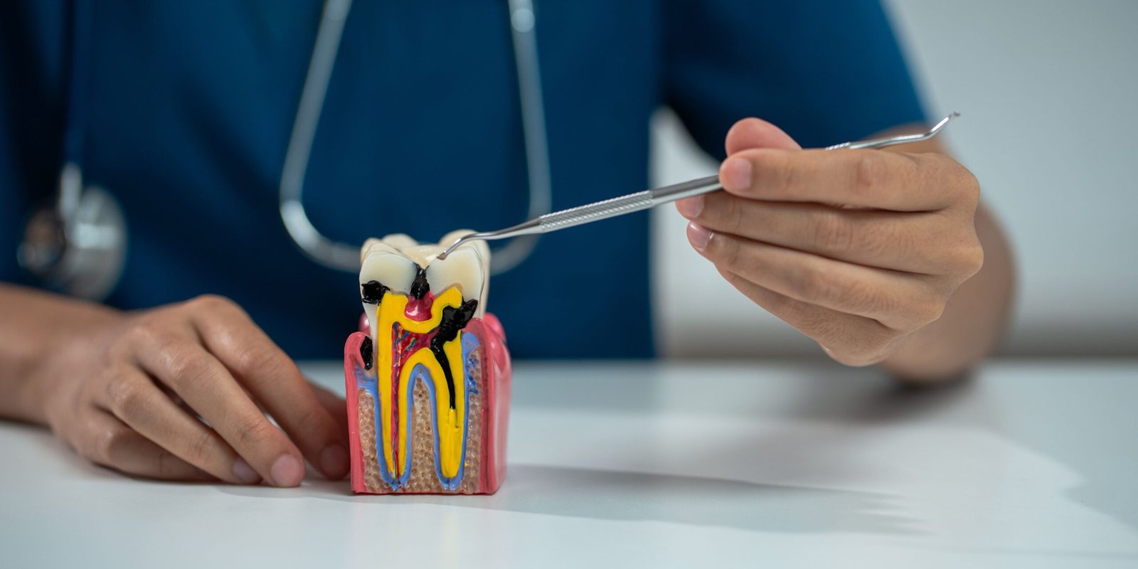 What is Root Canal Treatment