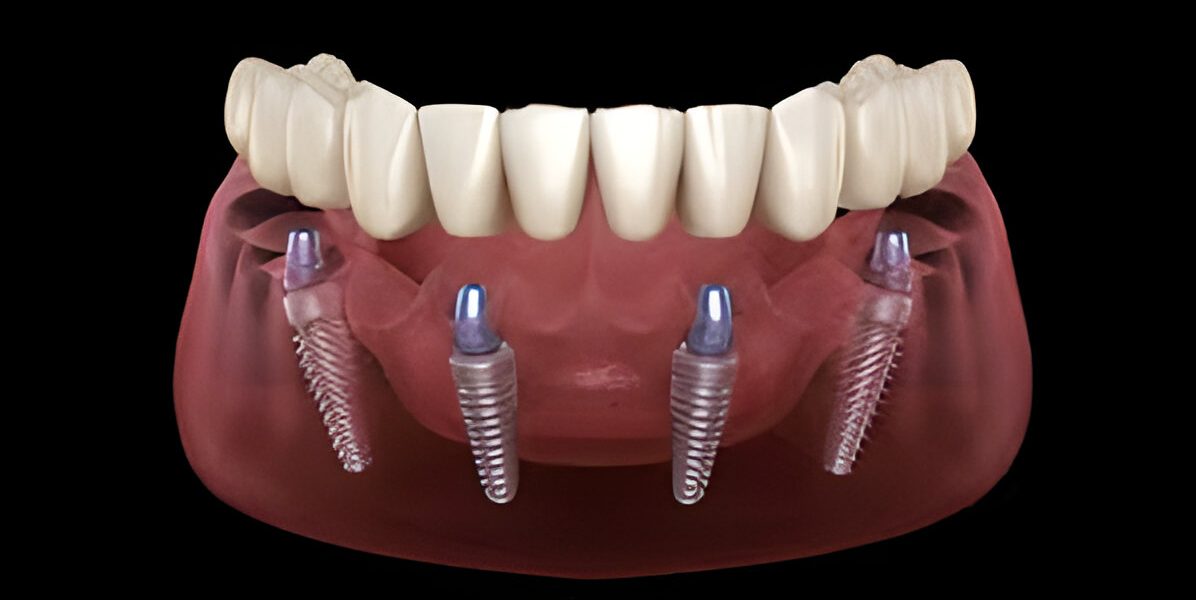 dental implant in chandigarh