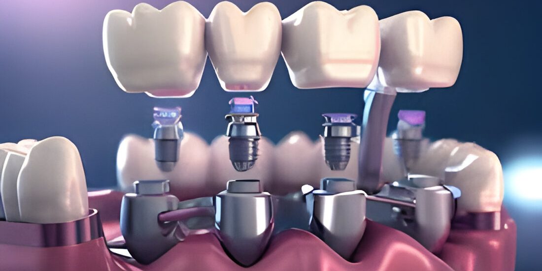 dental implant in chandigarh