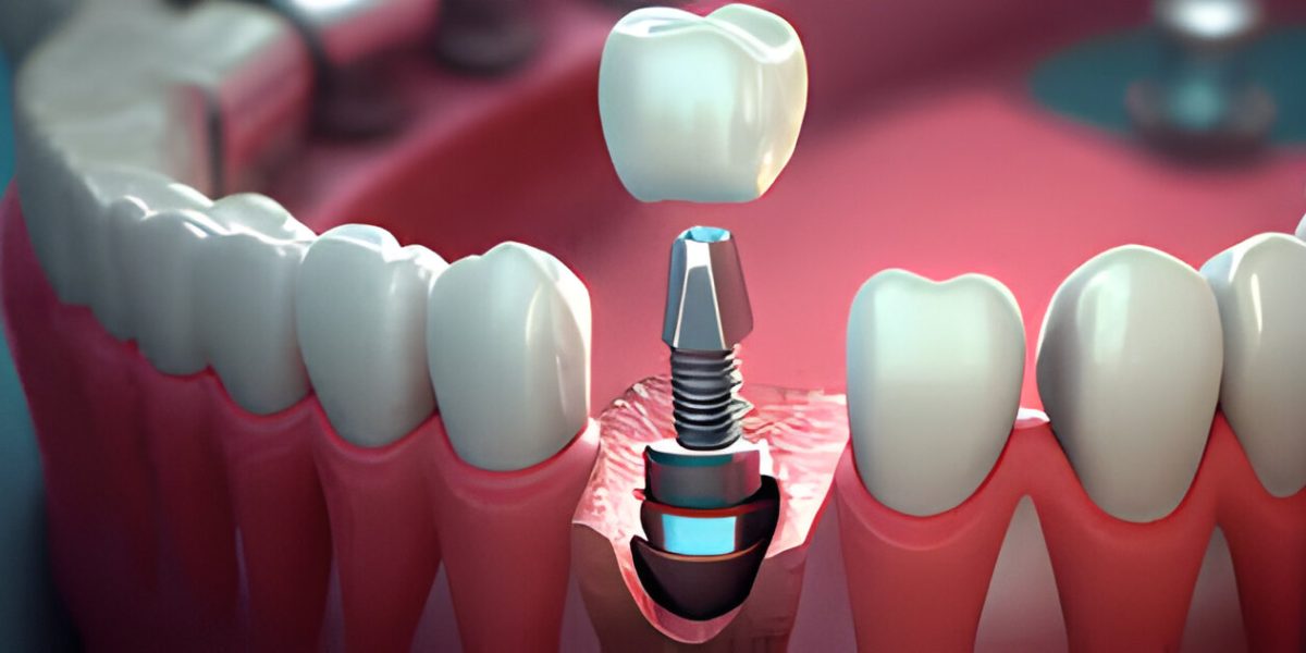 dental implant doctor in chandigarh